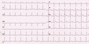 ecg    sss